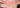 Rosacea Relief: Your Path to Calmer, Happier Skin